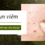 Da mụn viêm kéo dài, chăm như thế nào cho đúng?