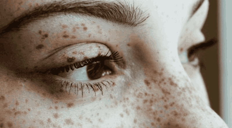 Phân biệt giữa nám, tàn nhang và thâm sau viêm: Hiểu đúng để chọn đúng 1