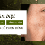 Phân biệt giữa nám, tàn nhang và thâm sau viêm: Hiểu đúng để chọn đúng 2