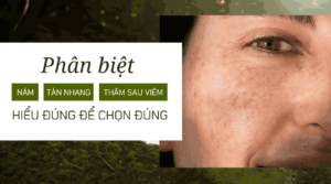 Phân biệt giữa nám, tàn nhang và thâm sau viêm: Hiểu đúng để chọn đúng 2