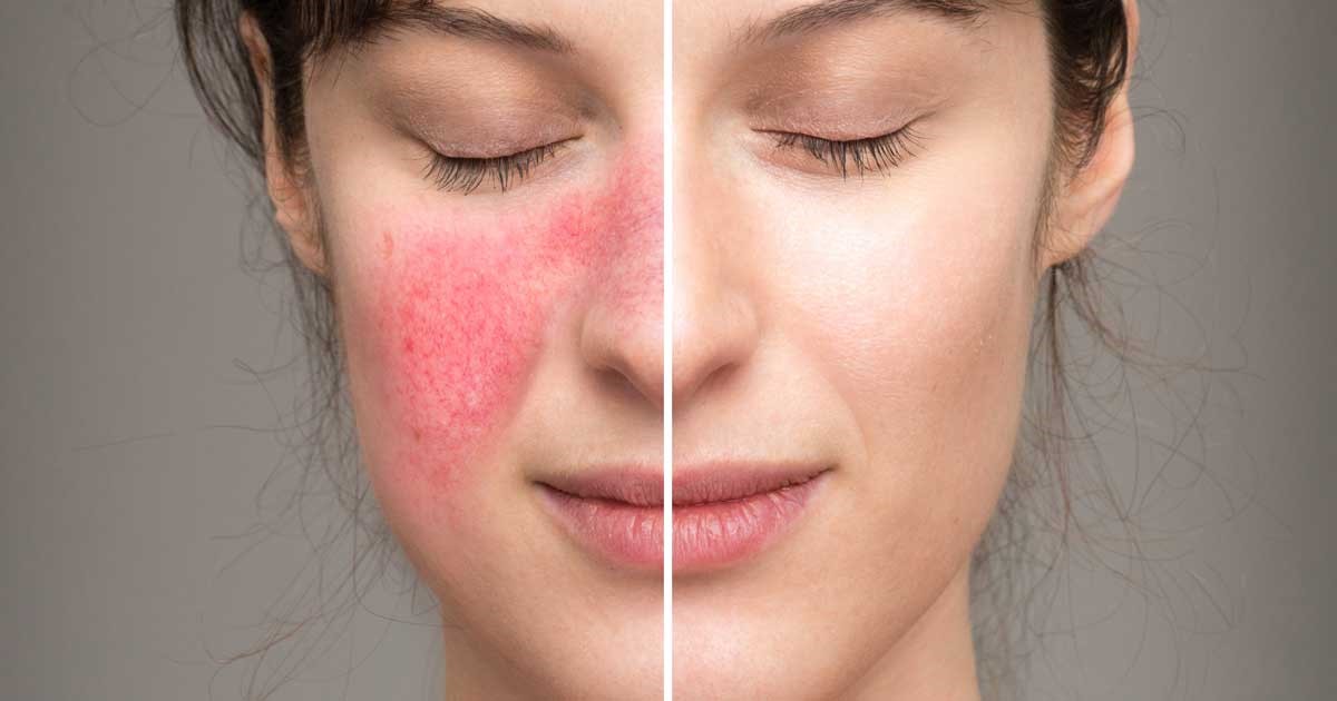 Mờ thâm nám, trắng sáng da cùng Dermeden Lumixderm Brightening Cream 5