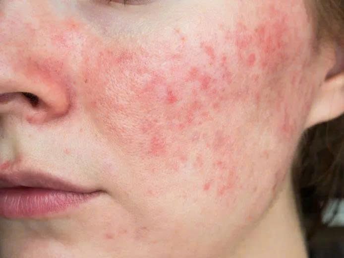 3-causes-of-sensitive-skin-a-science-backed-recovery-routine-from-nzheal-4